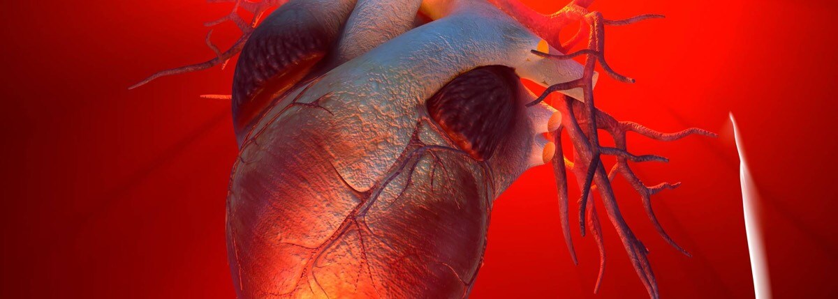 Reducción de la aparición de infartos